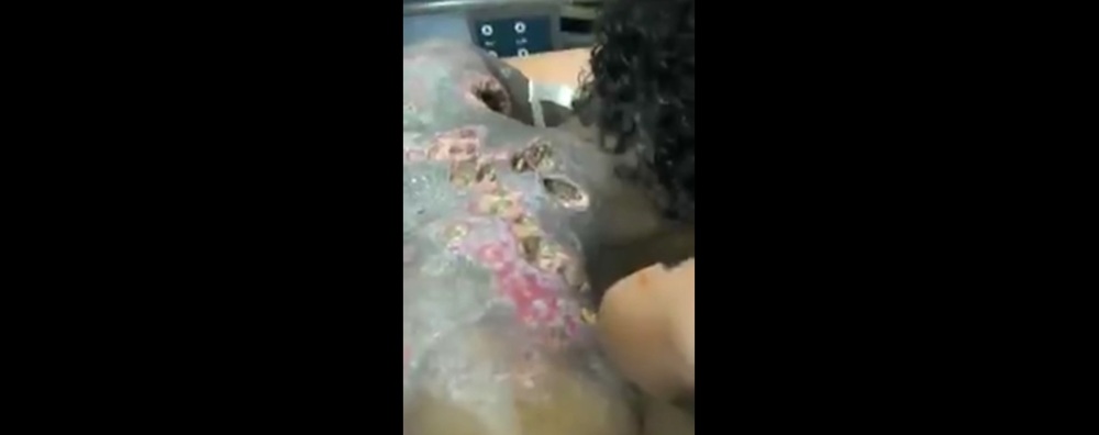 Тело бездомного изъедено червями 