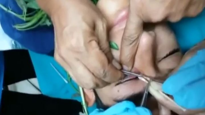 Во время операции врачи выманивали червя из глаза пациента с помощью базилика 