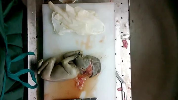 Аутопсия 2-х месячного младенца 