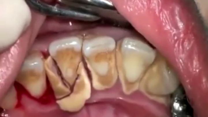 Процесс снятия зубного камня, собиравшегося на протяжении 10 лет 