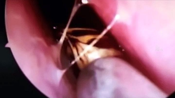 Врачи обнаружили живого таракана в носу женщины, после её жалоб на зуд   