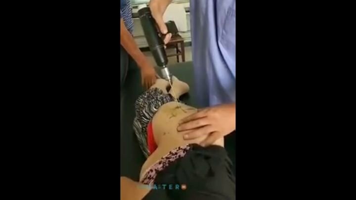 Китайский доктор просверливает пациентку дрелью 