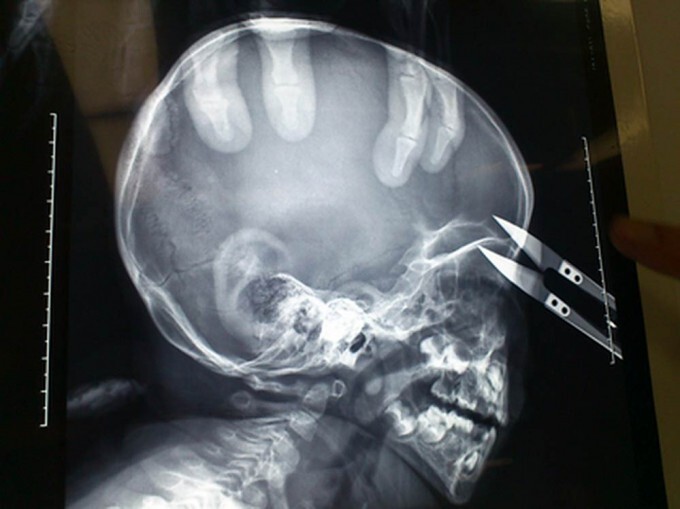 Малыш пробил голову ножницами