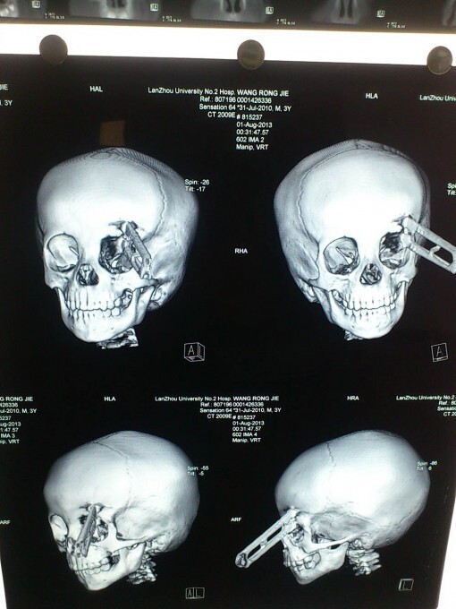 Малыш пробил голову ножницами