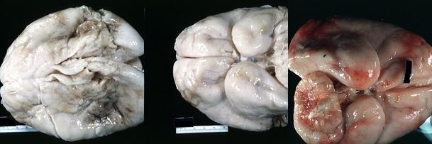 Мозг человека, страдающего лиссэнцефалией