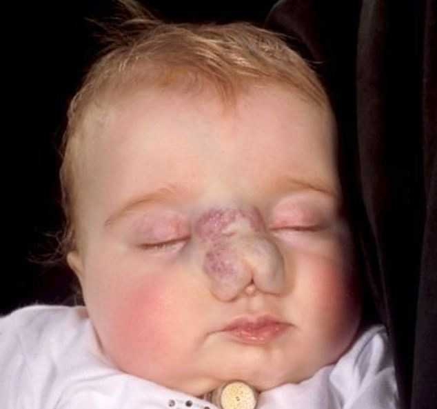 На носу у новорожденной выросла огромная фиолетовая опухоль