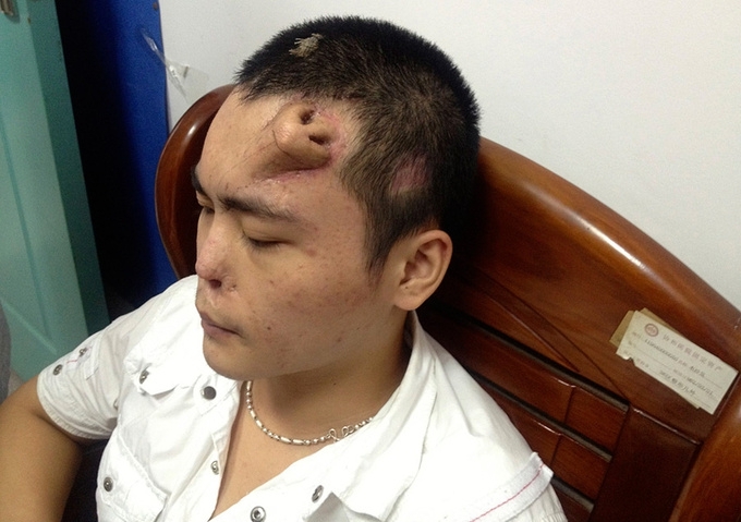 Китайское чудо: медики вырастили нос на лбу пациента