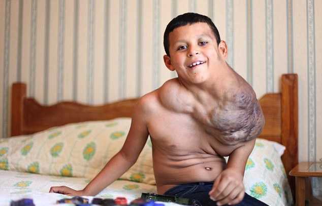 Десятилетнего мальчика с гигантской опухолью на шее спасет виагра