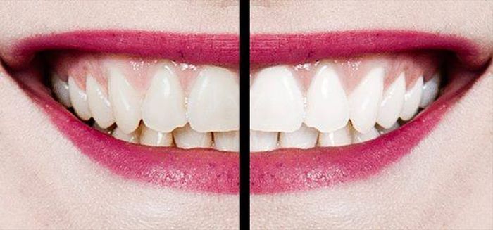 Знаешь ли ты, что отбелить зубы в домашних условиях можно намного эффективнее и дешевле, чем у стоматолога