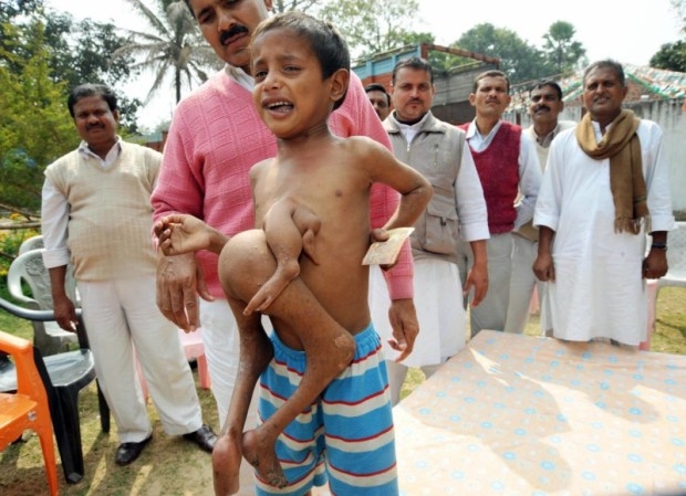 Индийский мальчик с лишними конечностями на груди