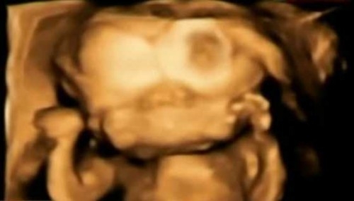 В Австралии ждут рождения двуликого ребенка