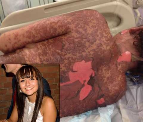 Таблетки от изжоги расплавили 17-летнюю девушку