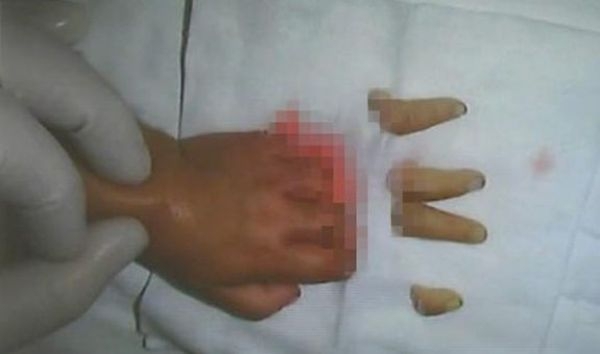 Девочка игралась с кухонным ножом и отрезала себе пальцы