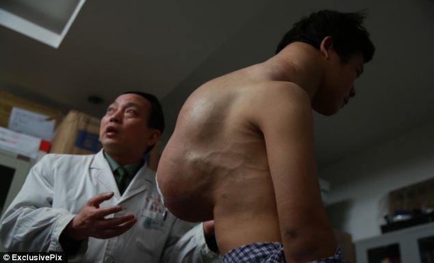 Хирурги срезали со спины китайца 10-килограммовый горб