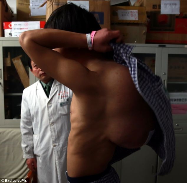 Хирурги срезали со спины китайца 10-килограммовый горб