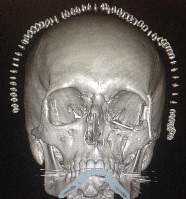 Медики распечатали жертве аварии новый череп
