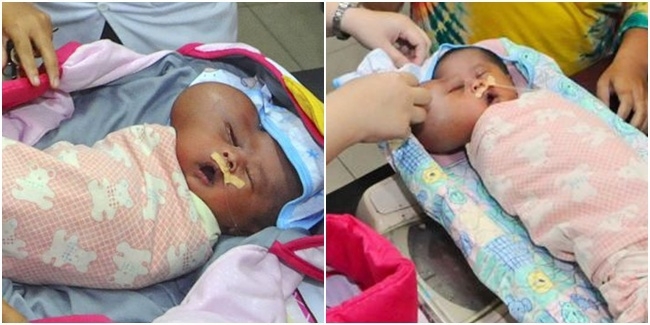 В Индонезии родился малыш Мухаммад Нафи с головой в форме сердца