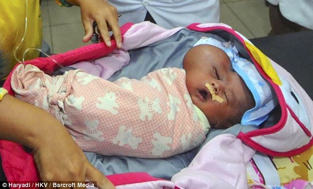 В Индонезии родился малыш Мухаммад Нафи с головой в форме сердца