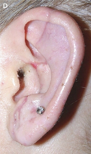 Как с помощью пиявок отремонтировать оторванное ухо