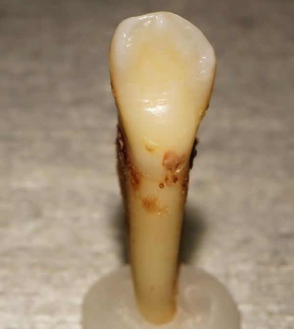 Как пломбируют корневые каналы в зубах