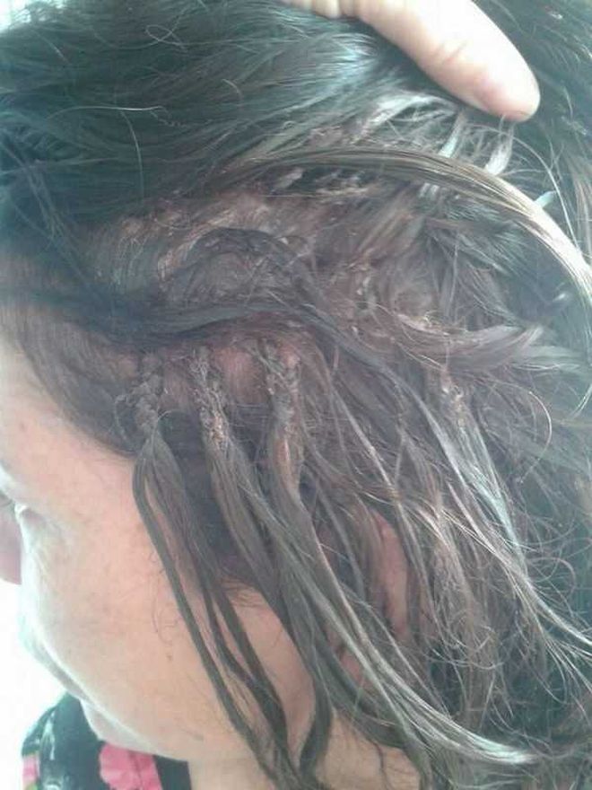 Домохозяйка осталась лысой после наращивания волос суперклеем