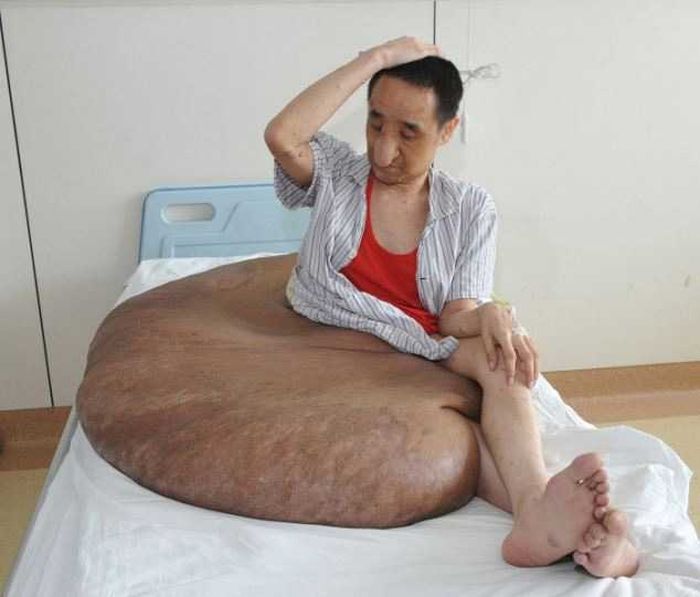 Врачи избавили жителя Китая от 110-килограммовой опухоли