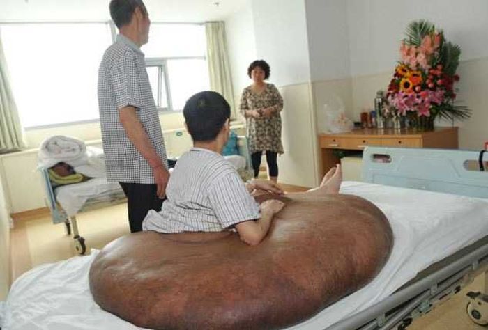 Врачи избавили жителя Китая от 110-килограммовой опухоли