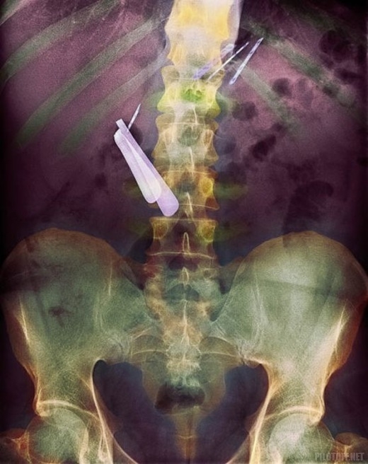 Страшные и нелепые снимки рентгена