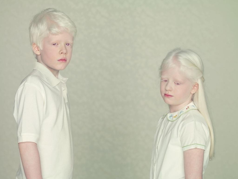 Не такие, как все: люди-альбиносы 