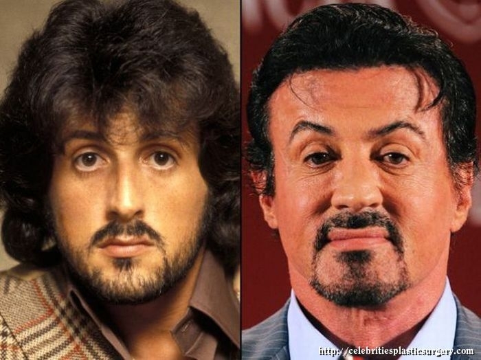 Голливудские знаменитости до и после пластических операций 