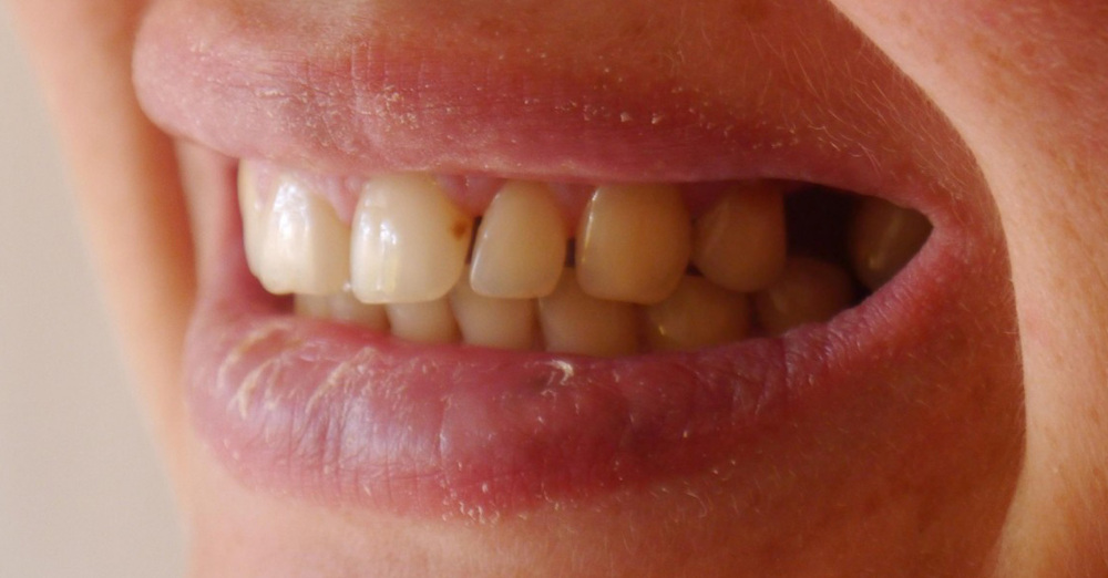 9. Плохие зубы