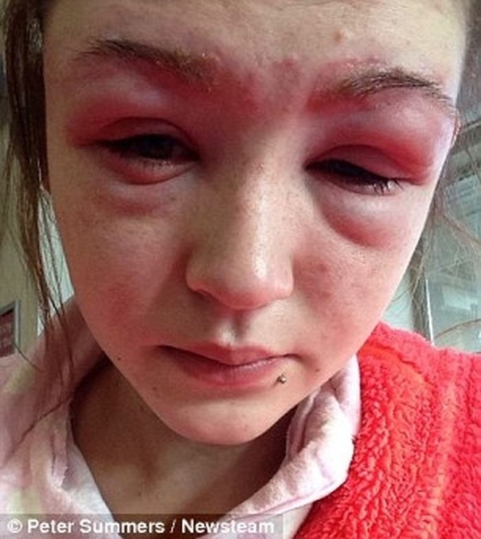 Девушка чуть не ослепла после аллергии на краску для ресниц