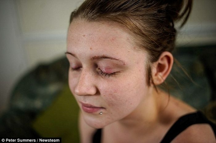 Девушка чуть не ослепла после аллергии на краску для ресниц