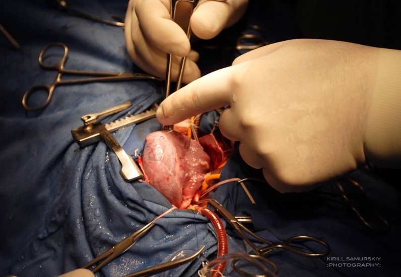 Операция на открытом сердце