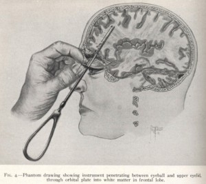 Жуткая и любопытная история лоботомии