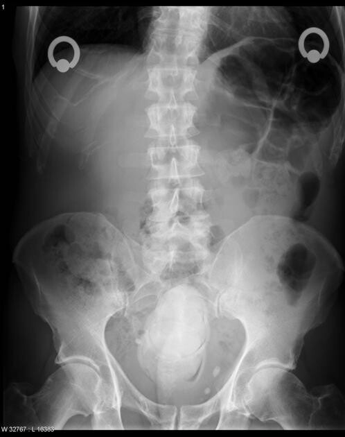 Удивительные рентгенограммы: инородные предметы в человеческом теле