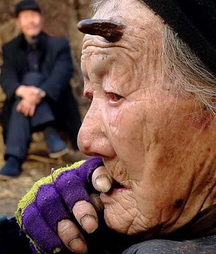 У столетней китайской бабушки растут рога  