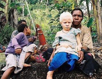 Альбинизм: не только среди белых