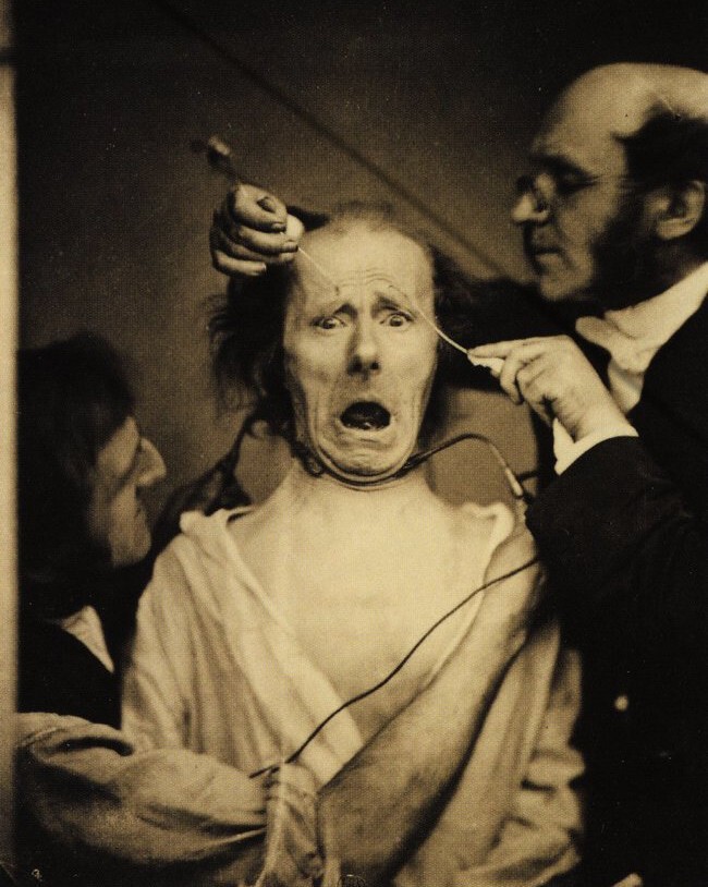 Невропатолог де Булонь подвергает этого беднягу разрядам электрического тока,  чтобы изучить мускулы его лица, 1860 г.