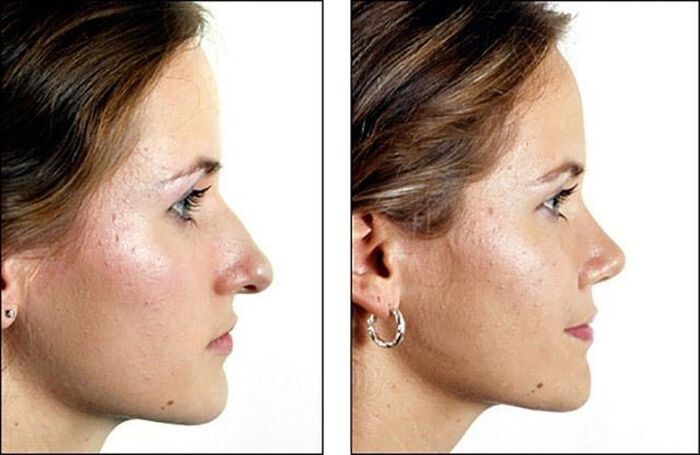 Как сильно пластика носа может изменить внешность человека