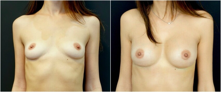 О том, как увеличивают женскую грудь. Внимание 18+
