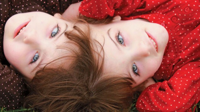 10. Некоторые сиамские близнецы могут видеть глазами друг друга и читать мысли друг друга