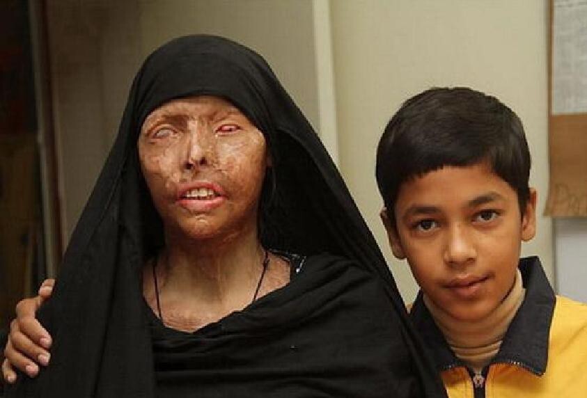 Наима Азар, пострадавшая от кислотной атаки собственного мужа