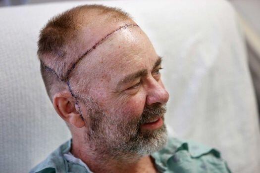Впервые в мире проведена пересадка черепа