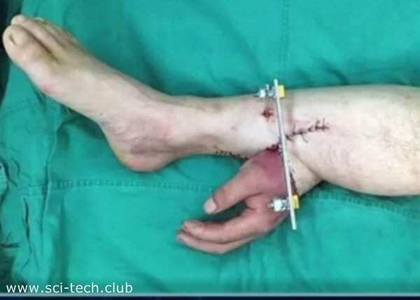 Чтобы спасти руку, врачи пришили ее к ноге пациента