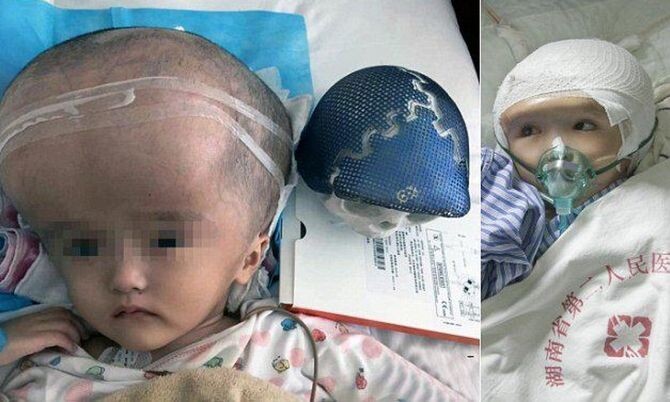Ребенку пересадили напечатанный на 3D-принтере череп
