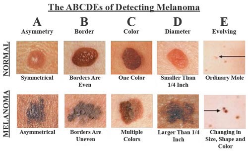 3. Миф: Большинство случаев рака кожи не опасны.