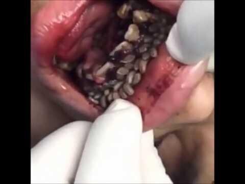 Гостиная червей в рот пациента 