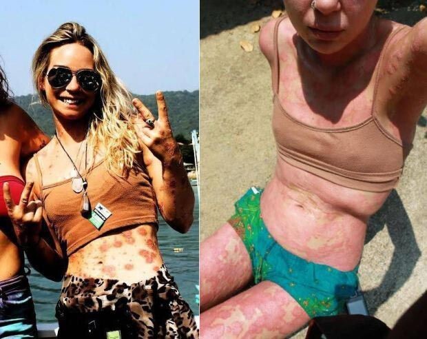 Девушка с тяжёлой формой псориаза показала своё тело в бикини