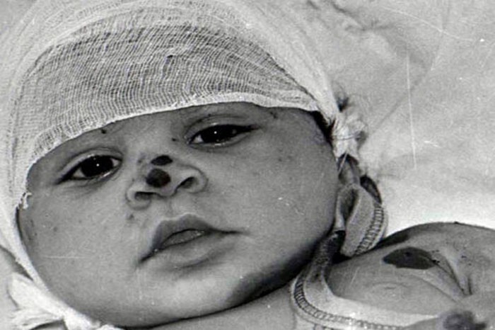 Фото № 6. Раненый ребенок - жертва Ходжалы.